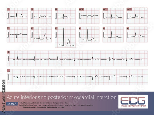 Male, 84 years old, admitted to hospital with chest pain for 1 day. ECG showed acute inferior and posterior MI and possibly right MI. The patient died of ventricular fibrillation the next day.
