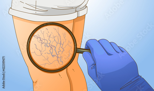 Human legs with health problems. Varicose veins. Diagnosis of varicose veins.  Vector illustration. Healthcare illustration.  