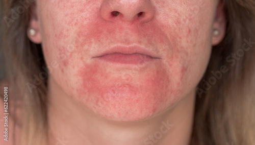 Seborrheic Dermatitis In the face of a young girl. Acne vulgaris and scars over whole face of Italian woman. close-up with focus on the problem.