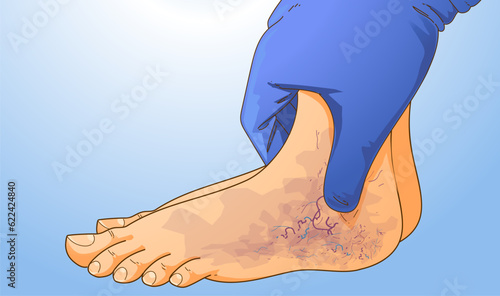 Human legs with health problems. Bruise, hematoma. Varicose veins. Vector illustration. Healthcare illustration.