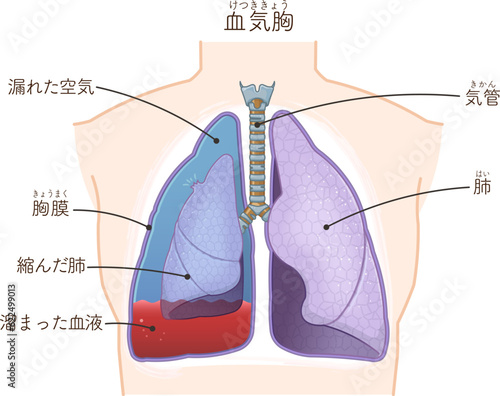 肺・気管・気胸・血胸・血気胸のイラスト