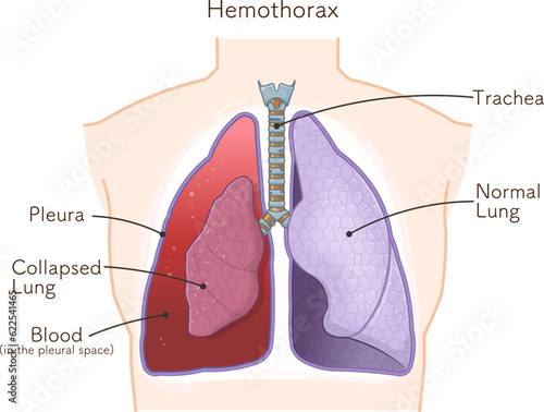 lungs,windpipe,hemothorax,pneumothorax,hemopneumothorax,illustration