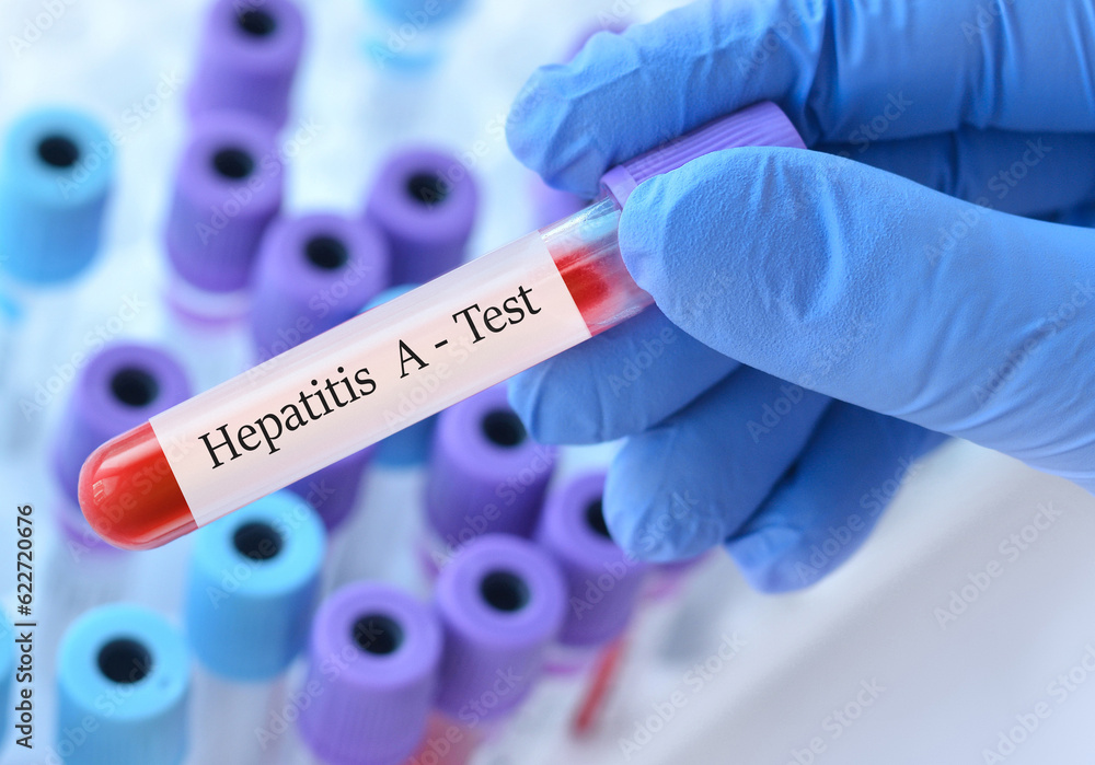 Obraz premium The doctor holds a test blood sample tube with hepatitis A virus (HAV) test on the background of medical test tubes
