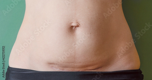Photo of a woman's abdomen after a caesarean section