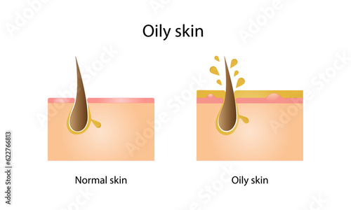 Oily skin. Comparison between normal and oily skin. Vector illustration.