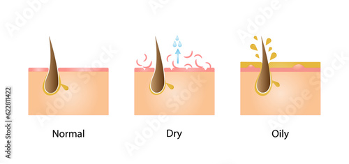 Normal, oily, and dry pores. Human Skin types and conditions on white background. Vector illustration.