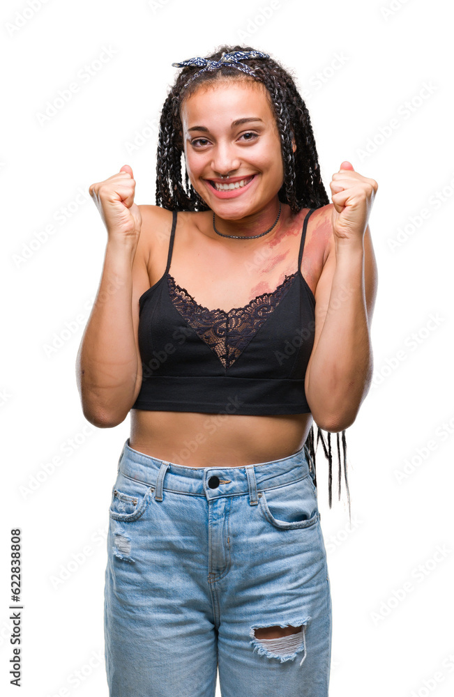 Young braided hair african american with pigmentation blemish birth mark over isolated background celebrating surprised and amazed for success with arms raised and open eyes. Winner concept. Young braided hair african american with pigmentation blemish birth mark over isolated background celebrating surprised and amazed for success with arms raised and open eyes. Winner concept.