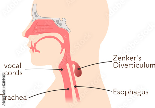 Zenker's Diverticulum,illustration