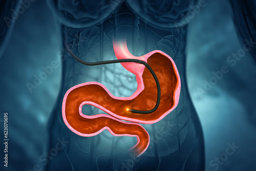 Human Stomach with endoscope and close-up view of bacterium Helicobacter pylori which causes ulcers, stomach ulcer or gastric ulcer, 3d illustration photo
