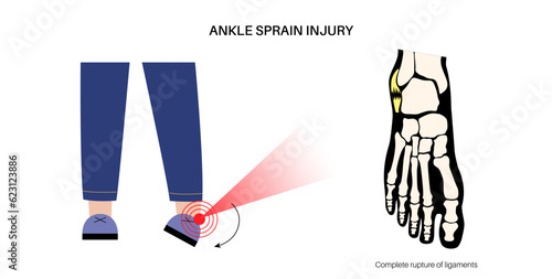 Sprained ankle injury