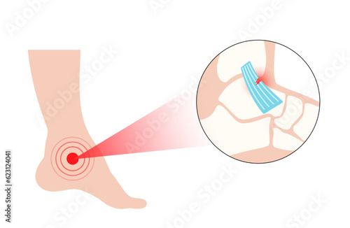 Sprained ankle injury