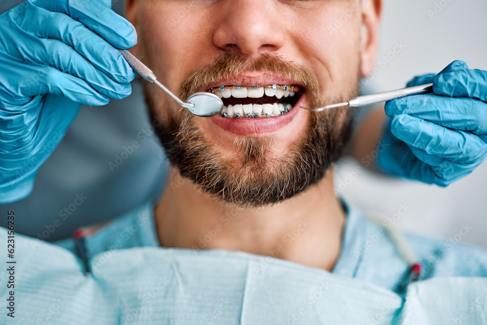 Cropped portrait of handsome man with braces sitting in dental chair. Doctor in gloves holding examination tools behind. Braces, alignment of teeth. - obrazy, fototapety, plakaty 