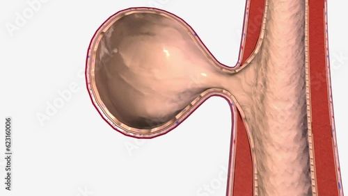 Berry (saccular) aneurysms are the most common type of intracranial aneurysm