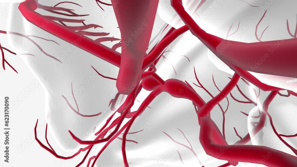 cerebral aneurysm is a weak or thin spot on an artery in the brain that