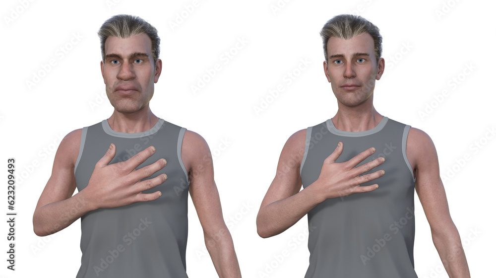 A man suffering from acromegaly, 3D illustration A man suffering from acromegaly, 3D illustration