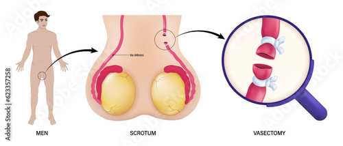 Men, scrotum and vasectomy vector. Vasoligation. Male sterilization procedure. Permanent contraception. 