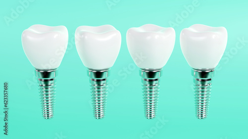 3d rendering of tooth implants with ceramic crowns on color background, Modern dental surgery concept