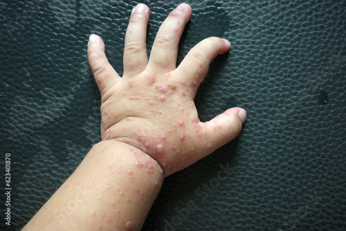 the hand of a baby with multiple red, swollen blisters, which are symptoms of hand, foot, and mouth disease. This is a viral illness in humans caused by the Picornaviridae family of enteroviruses photo