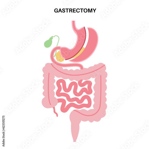 Surgical sleeve gastrectomy