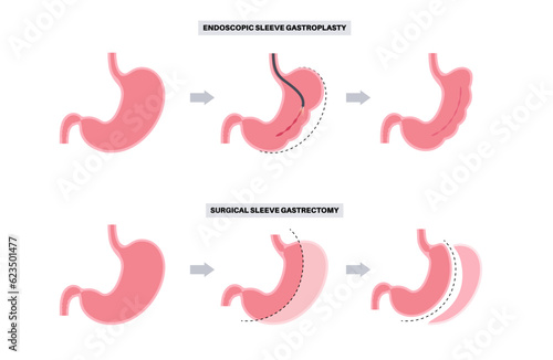 Gastrectomy and gastroplasty