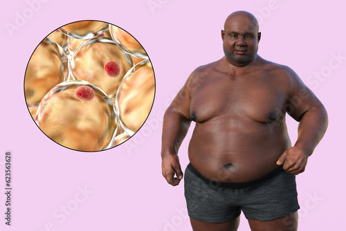An overweight man with a close-up view of adipocytes, 3D illustration highlighting the role of these fat cells in obesity photo