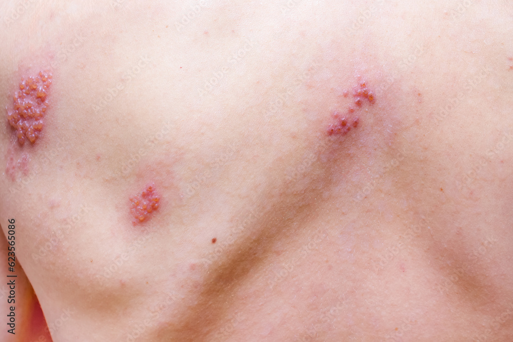 Fototapeta premium Shingles on men herpes zoster. Closeup.