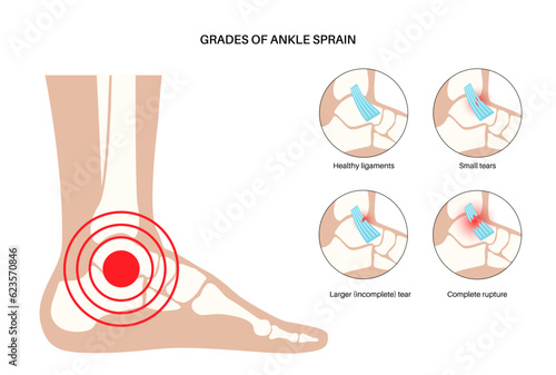 Sprained ankle injury