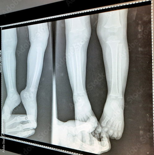 Plain x Ray PXR of right and left feet, ankles and legs of skeletally immature male patient child 18 months 2 views fixed by parent hands showing normal x ray after a trauma to the feet photo