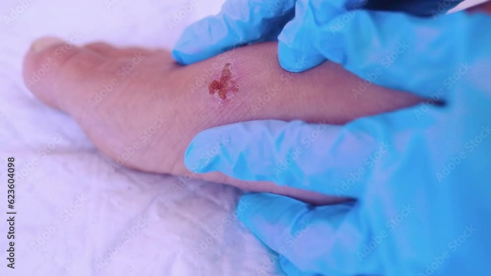 doctor treats weeping wound, trophic ulcer on female leg, wound exudate prevents healing ulcers by destroying growth factors, concept eliminating inflammatory process, sanitation pathogenic microflora doctor treats weeping wound, trophic ulcer on female leg, wound exudate prevents healing ulcers by destroying growth factors, concept eliminating inflammatory process, sanitation pathogenic microflora
