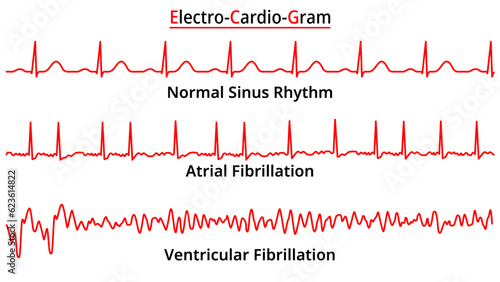 Set of ECG Common Abnormalities - Atrial Fibrillation - Ventricular Fibrillation - Normal Sinus Rhythm - Electrocardiography Vector Medical Illustration