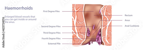 Hemorrhoids, or piles, are a common issue. These swollen veins inside of your rectum or outside of your anus can cause pain, anal itching and rectal bleeding. vector. Eating more fiber can help.
