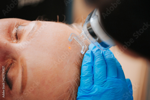 Procedure Laser resurfacing is a procedure in which a laser beam removes the dead skin layer