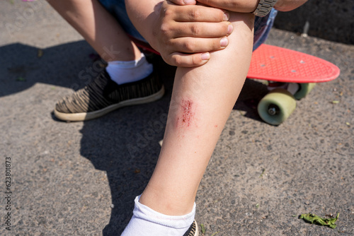 an abrasion on a child's leg from falling on an asphalt path  photo
