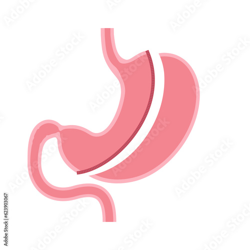 Surgical sleeve gastrectomy
