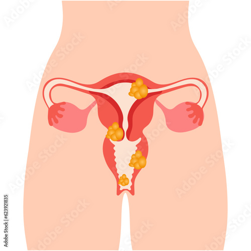 Woman's reproductive system disease polyps, fibroids in vector illustration  photo