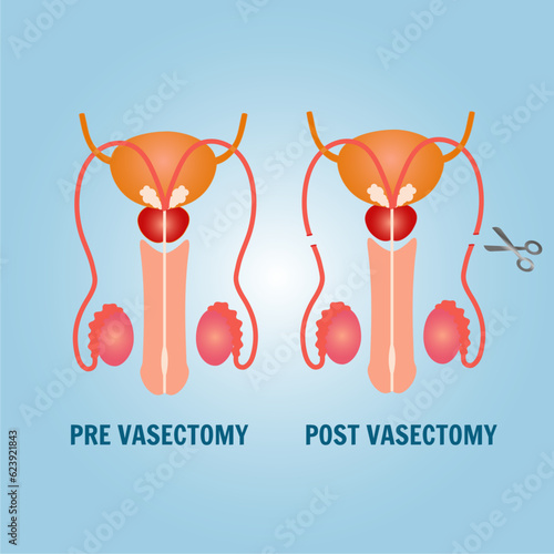 Male  vasectomy infographic in vector illustration 