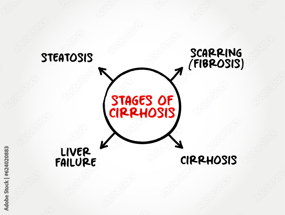 Stages of cirrhosis (scarring of the liver caused by longterm liver