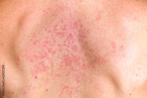 Print op canvas Skin fungus on his back. Red spots on the backs of men. Mold.