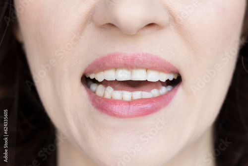 Canvas Print Woman shows off her chipped teeth. Bruxism, stress, malocclusion.