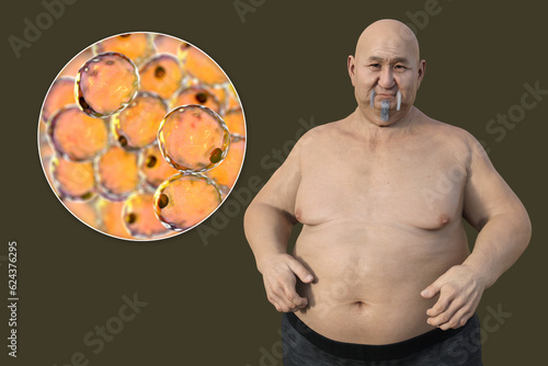 An overweight man with a close-up view of adipocytes, 3D illustration highlighting the role of these fat cells in obesity