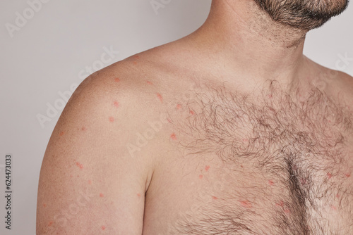 Shoulder and chest of a man with acne, red spots, skin disease photo