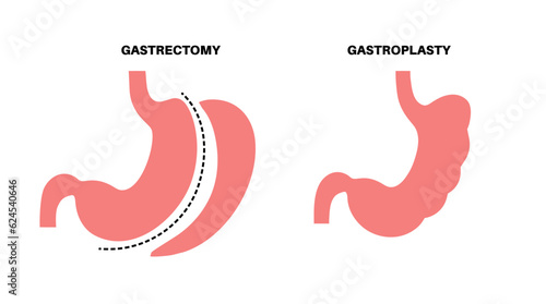 Gastrectomy and gastroplasty