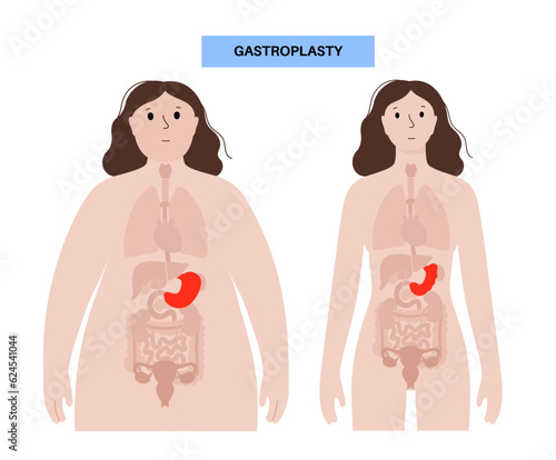 Endoscopic sleeve gastroplasty