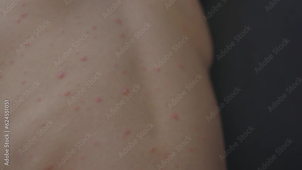 viral disease childhood illness chicken pox pimples symptoms on child's