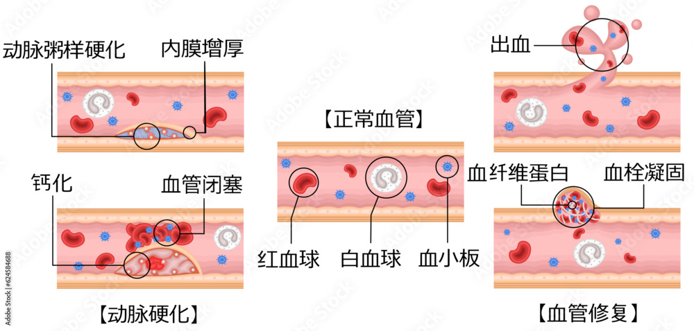 血管　動脈硬化　血管修復　イラスト　中国語