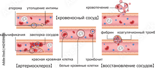血管　動脈硬化　血管修復　イラスト　ロシア語
