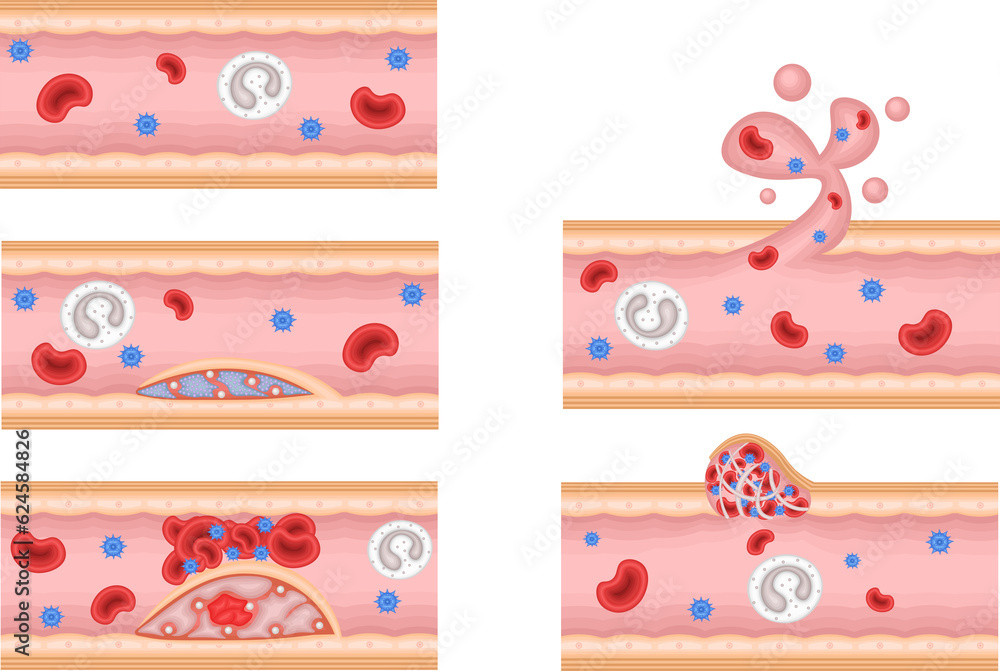 血管 動脈硬化 血管修復 イラスト Stock Illustration | Adobe Stock
