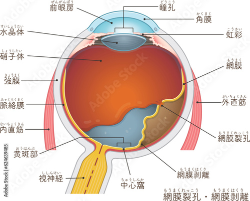 眼球・網膜裂孔・網膜剥離・retinal tear・retinal detachment・イラスト・eye・illustration