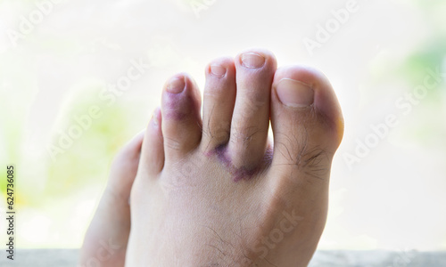 Broken toe is a common fracture. Male foot swollen with bruises after stubbing injury. Orthopedic doctor patient, traumatologist or pediatric treatment.