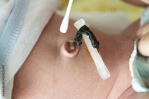 Treatment of the navel and umbilical cord of a newborn with hydrogen peroxide and a cotton swab to dry and heal the umbilical cord of an infant. Medical photo